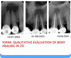 RCT for Apical pathologies